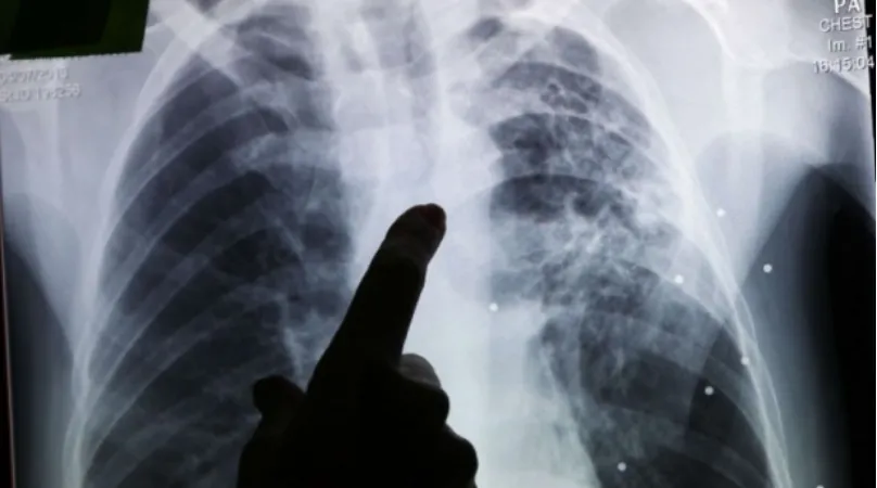 Over Half of New Tuberculosis Cases in Morocco in 2025 Are Extrapulmonary, Says Health Ministry