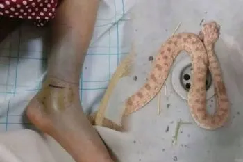 Health Group of Fes-Meknes Clarifies Incident of Snakebite in Taounate
