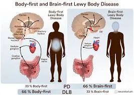 Understanding Lewy Body Disease: A Common Yet Overlooked Neurodegenerative Disorder